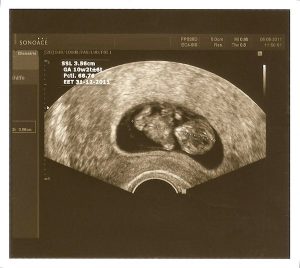 Ultraschallbild von Embryo im Mutterleib